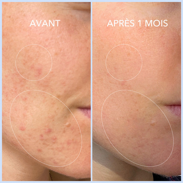 ACNÉ HORMONALE